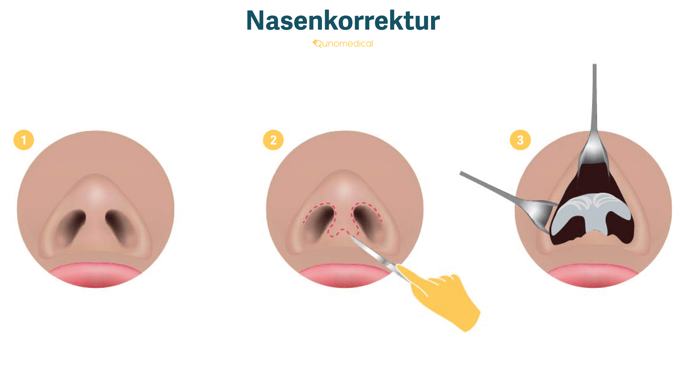 Schematische Darstellung einer Nasenplastik.