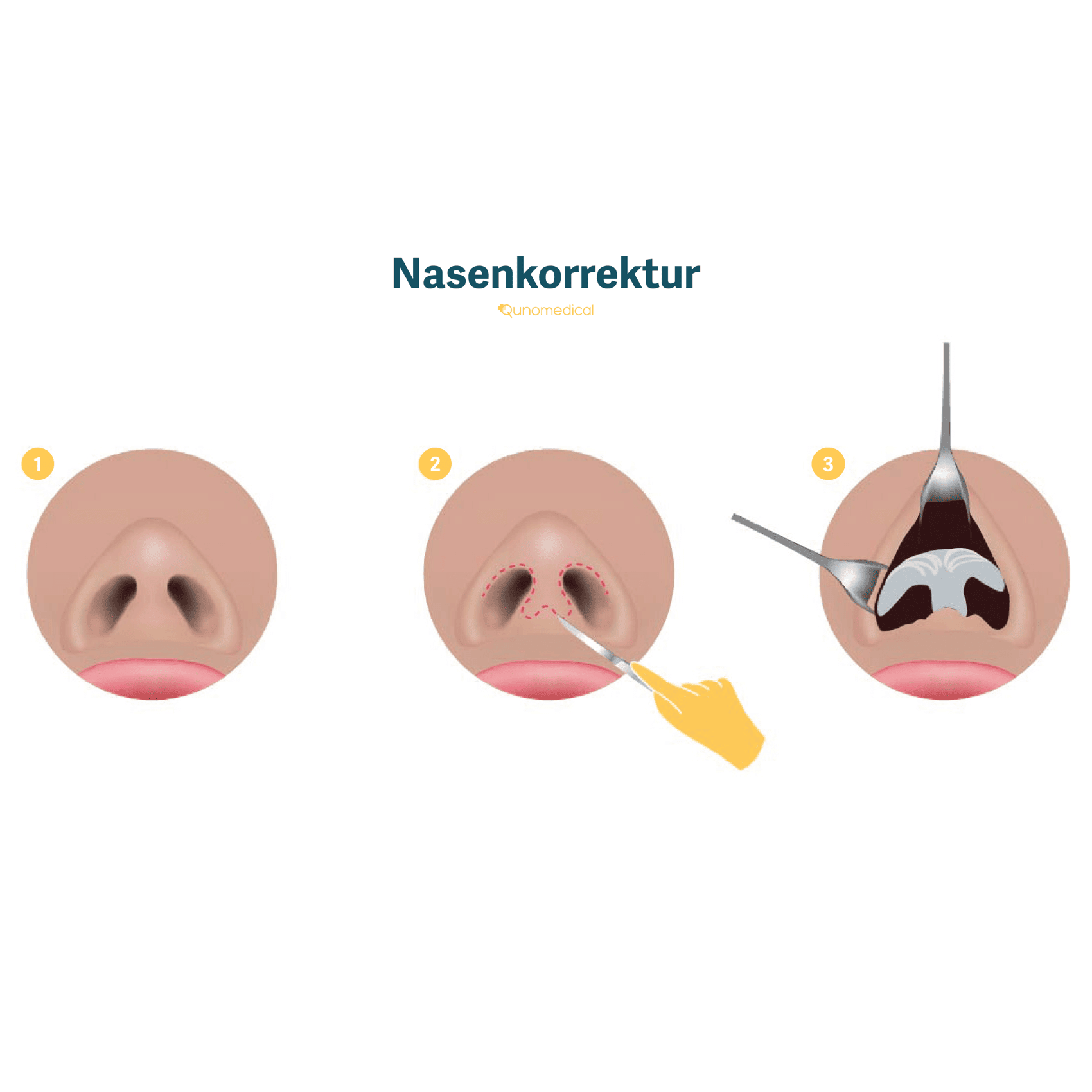Schematische Darstellung einer Nasenplastik.