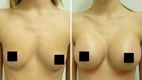 Image showing woman's breasts before and after undergoing breast implant surgery.