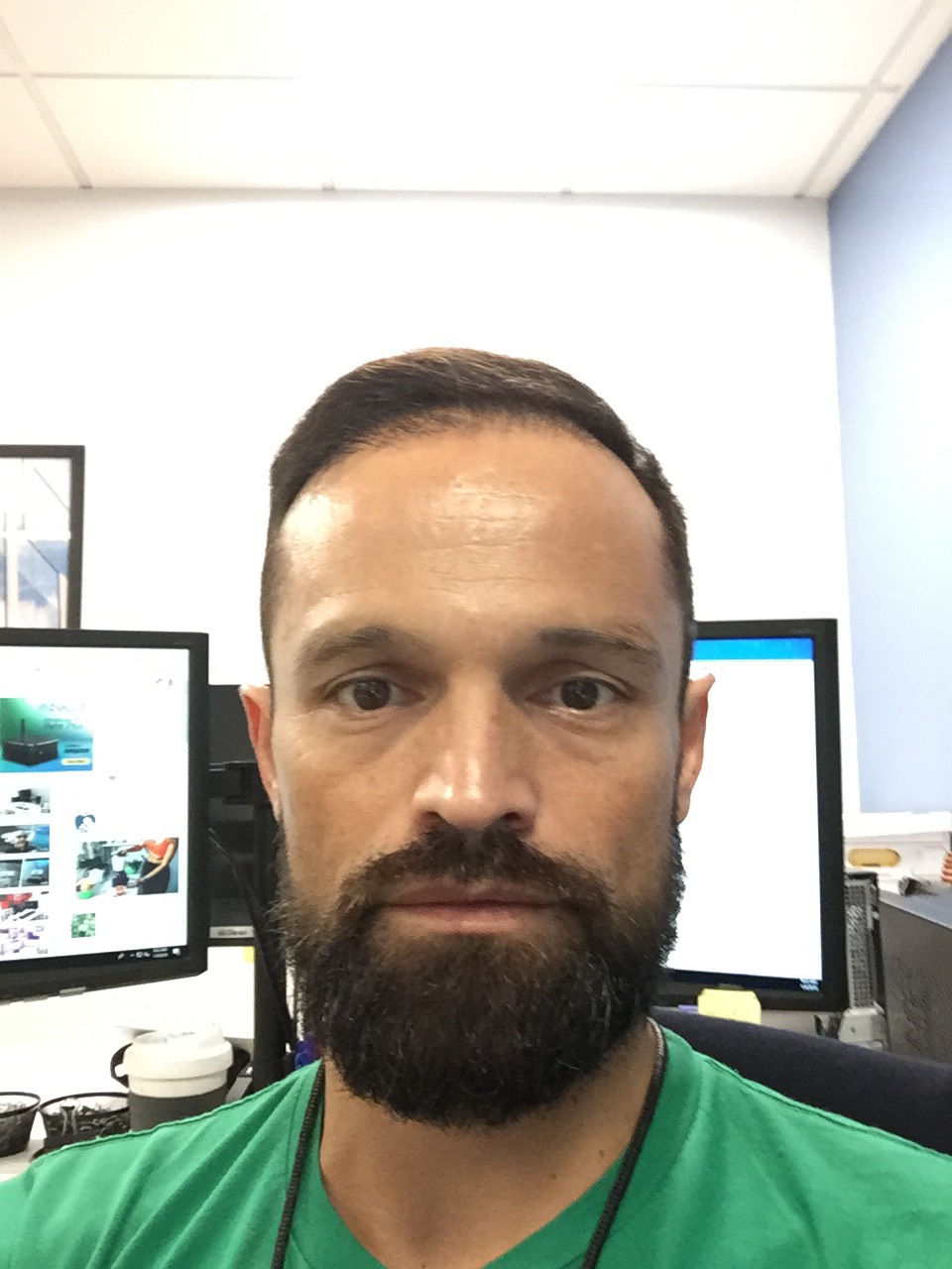 Image1_Freddy’s Hair Transplant: 6 Months Later