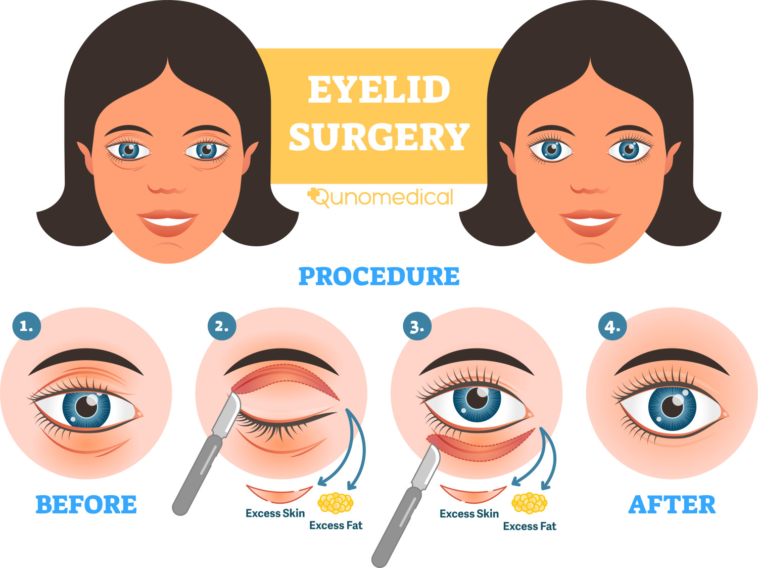 EN image 1 for Blepharoplasty Cost Guide