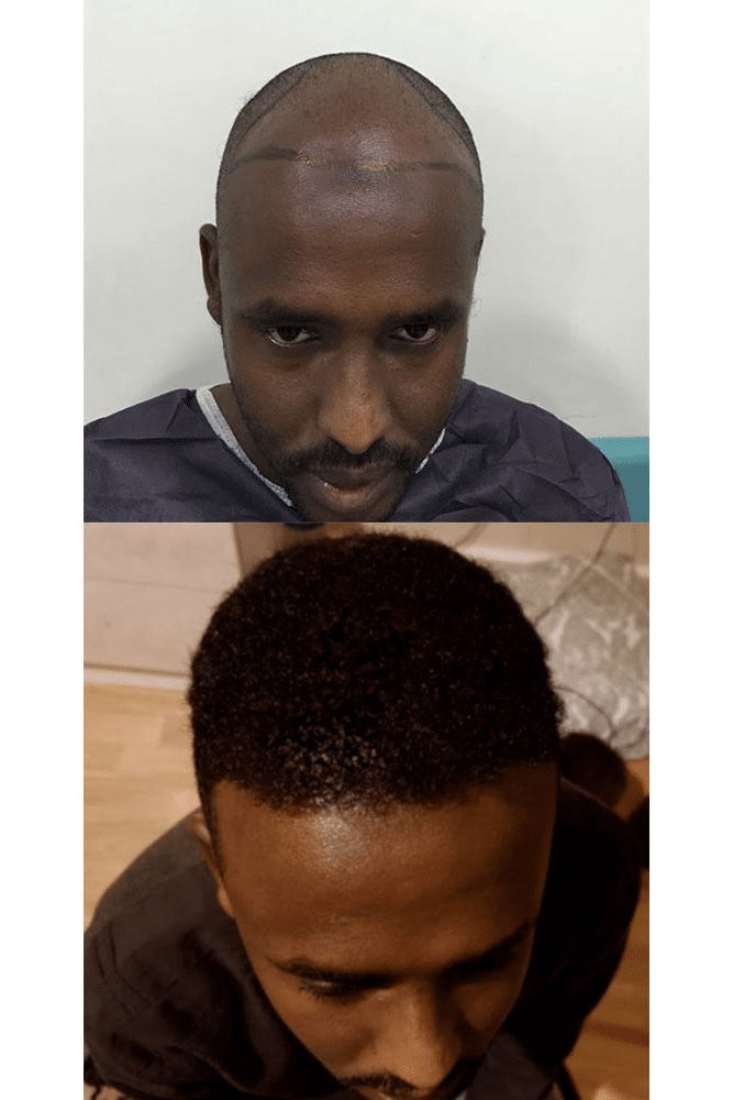 Afro hair transplant at Smile Hair Clinic at Moodist Hospital