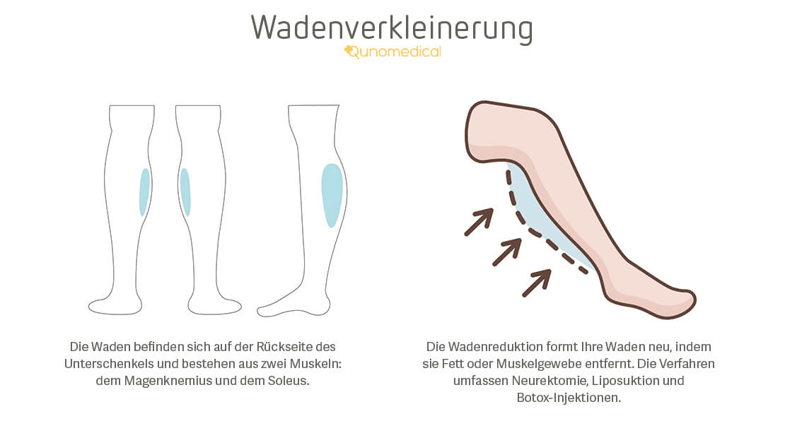 Wadenverkleinerungs-Infografik