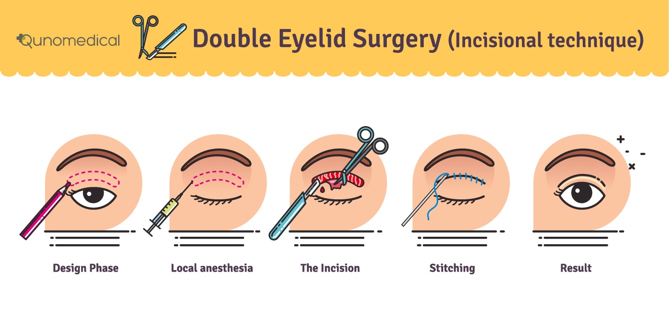 EN image 3 for Blepharoplasty Cost Guide