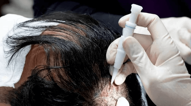 Hair graft harvesting and transplanting process