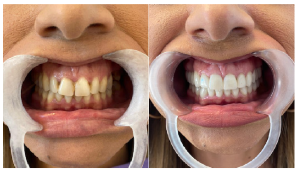 Patient zeigt seine Zähne vor und nach einer Behandlung mit Veneers.