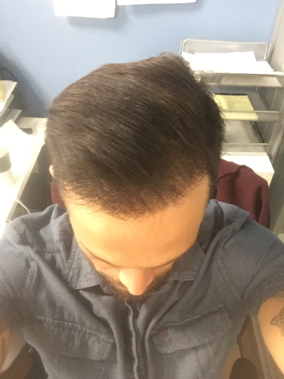 Image5_Freddy’s Hair Transplant: 6 Months Later