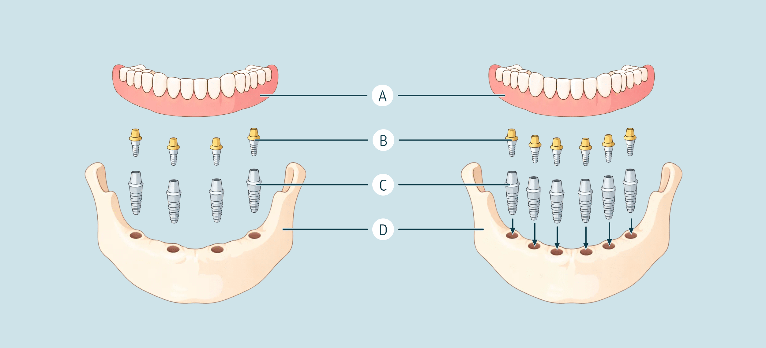 All-on-4 vs All-on-6