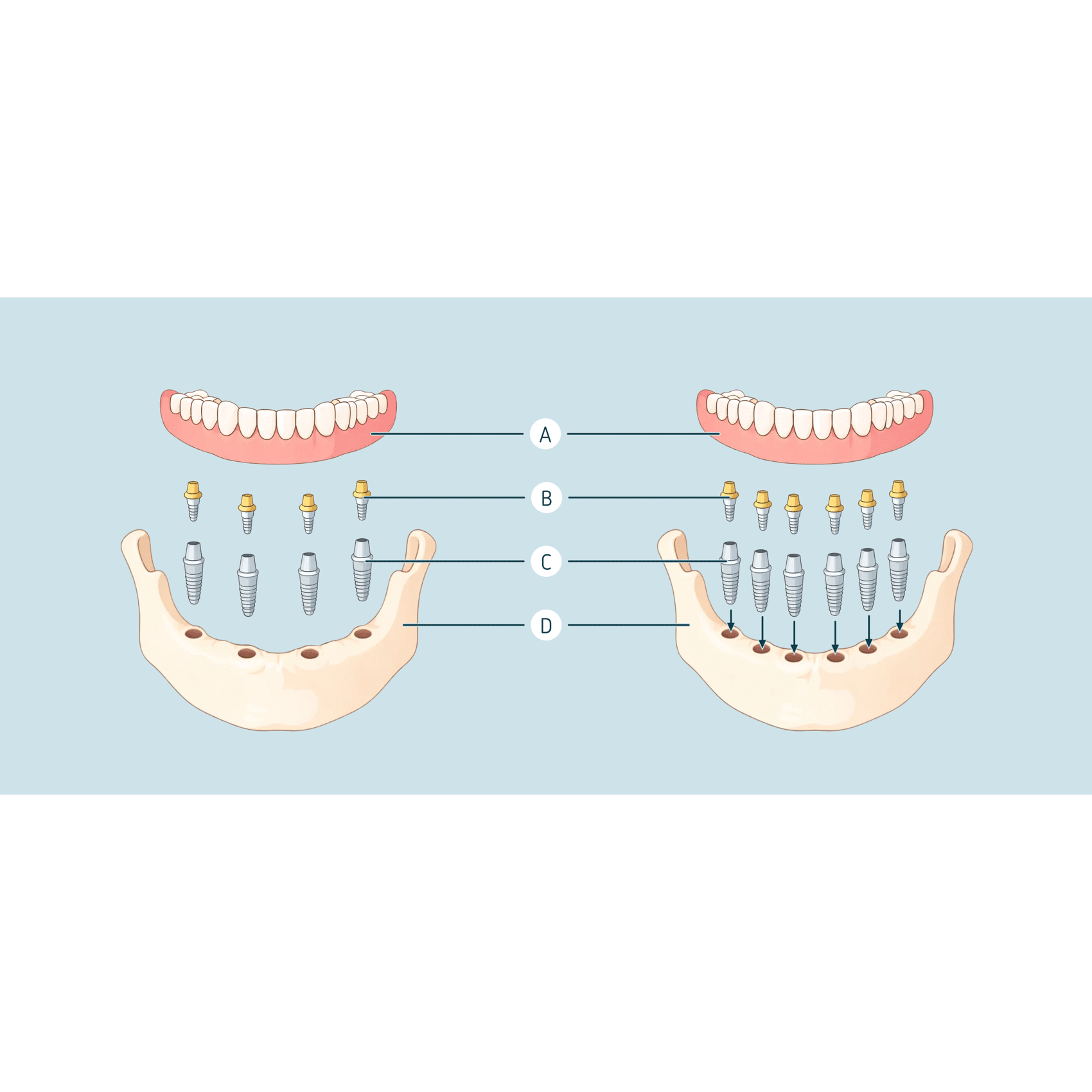 All-on-4 vs All-on-6