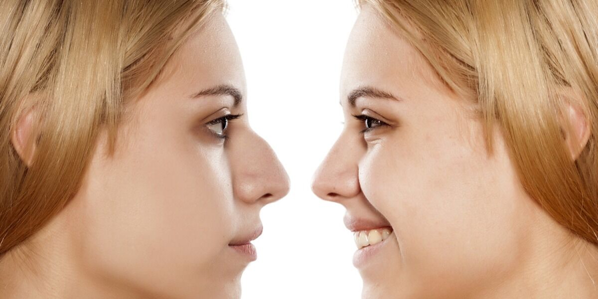 Before and after image rhinoplasty of blond women