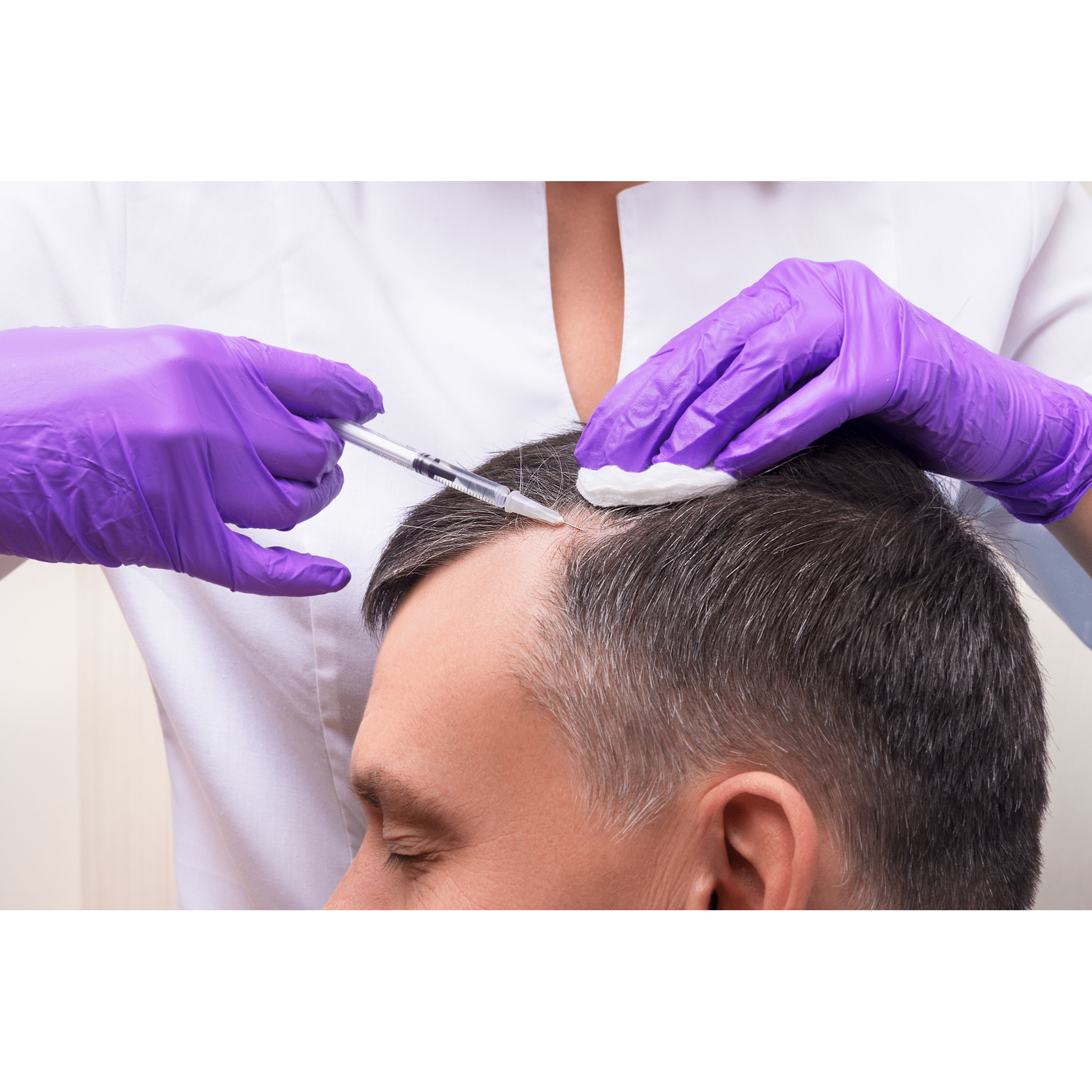 Man getting PRP therapy done on his balding head