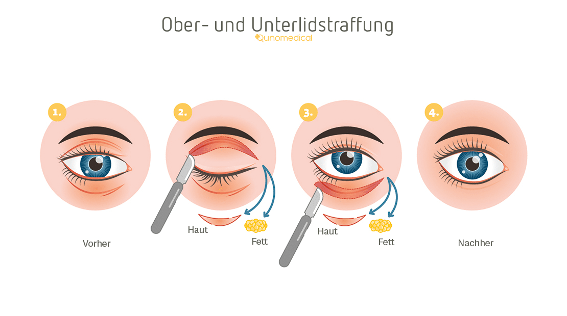 TP_Augenlidstraffung-Ablauf