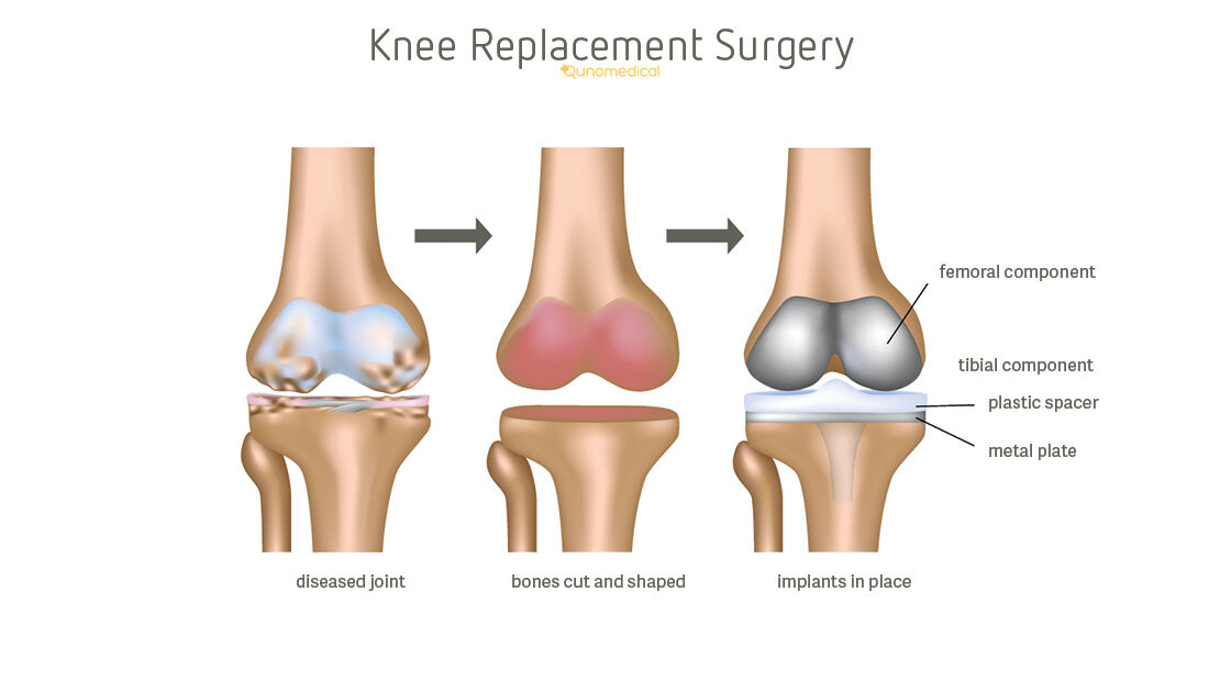 EN Gallery image 2 for knee-replacement