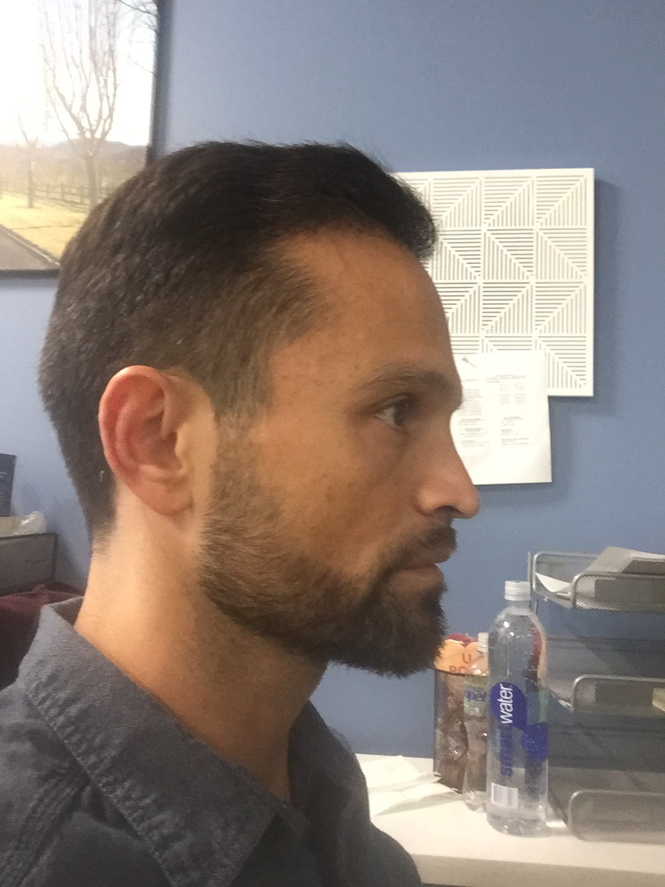 Image4_Freddy’s Hair Transplant: 6 Months Later