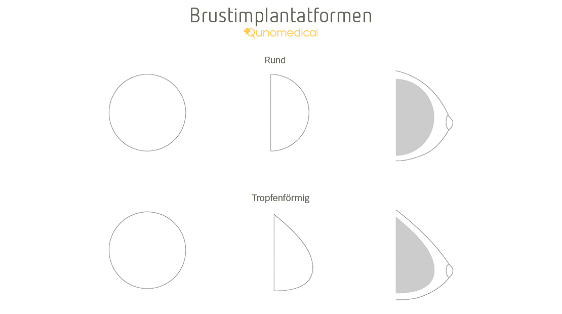 DE Gallery image 3 for brustvergrosserung-mit-implantaten
