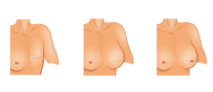 Illustration eines Beispiels für eine rekonstruktive brustchirurgische Behandlung.
