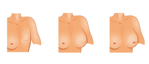 Illustration of an example of a reconstructive breast surgery treatment.
