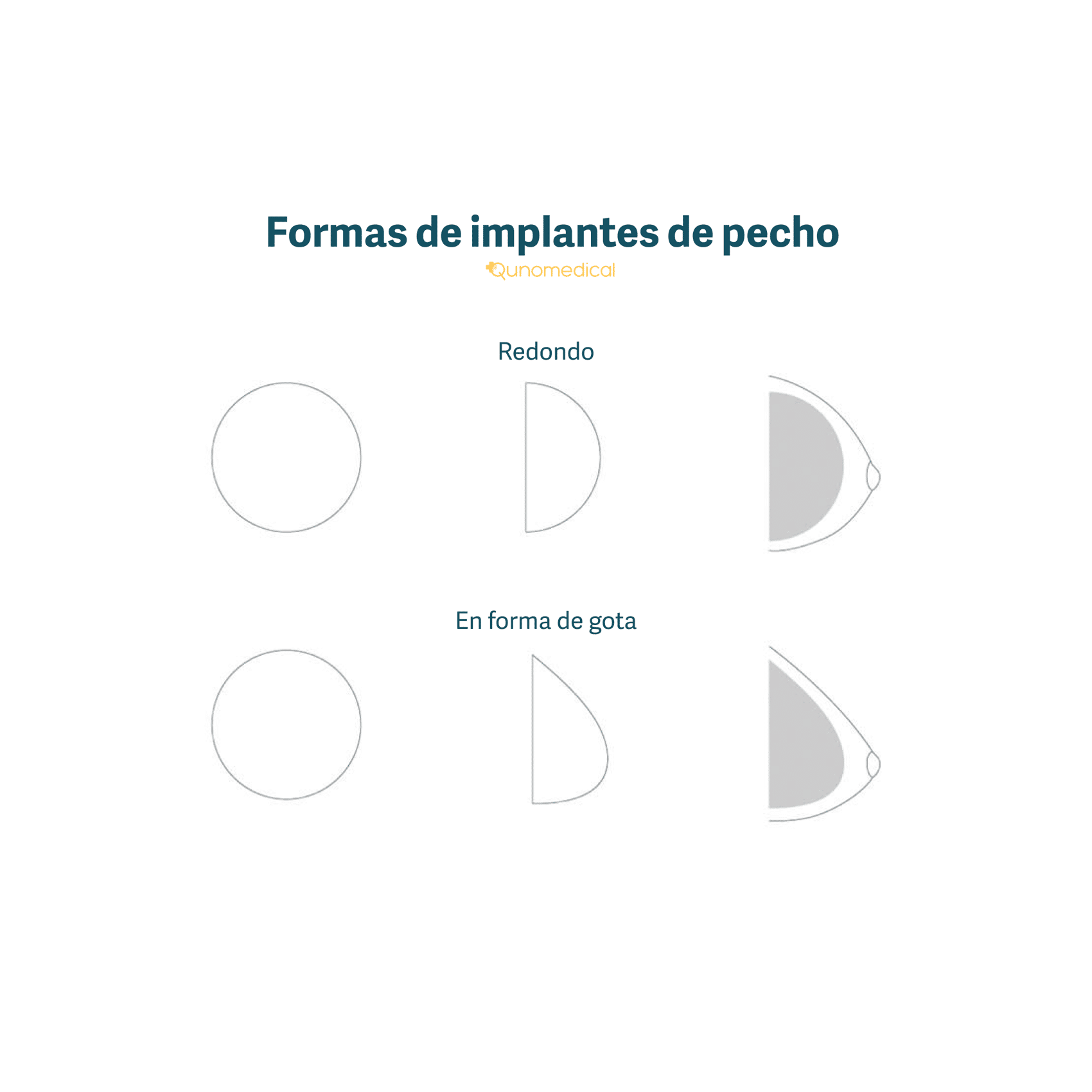 Las diferentes formas de los implantes mamarios.
