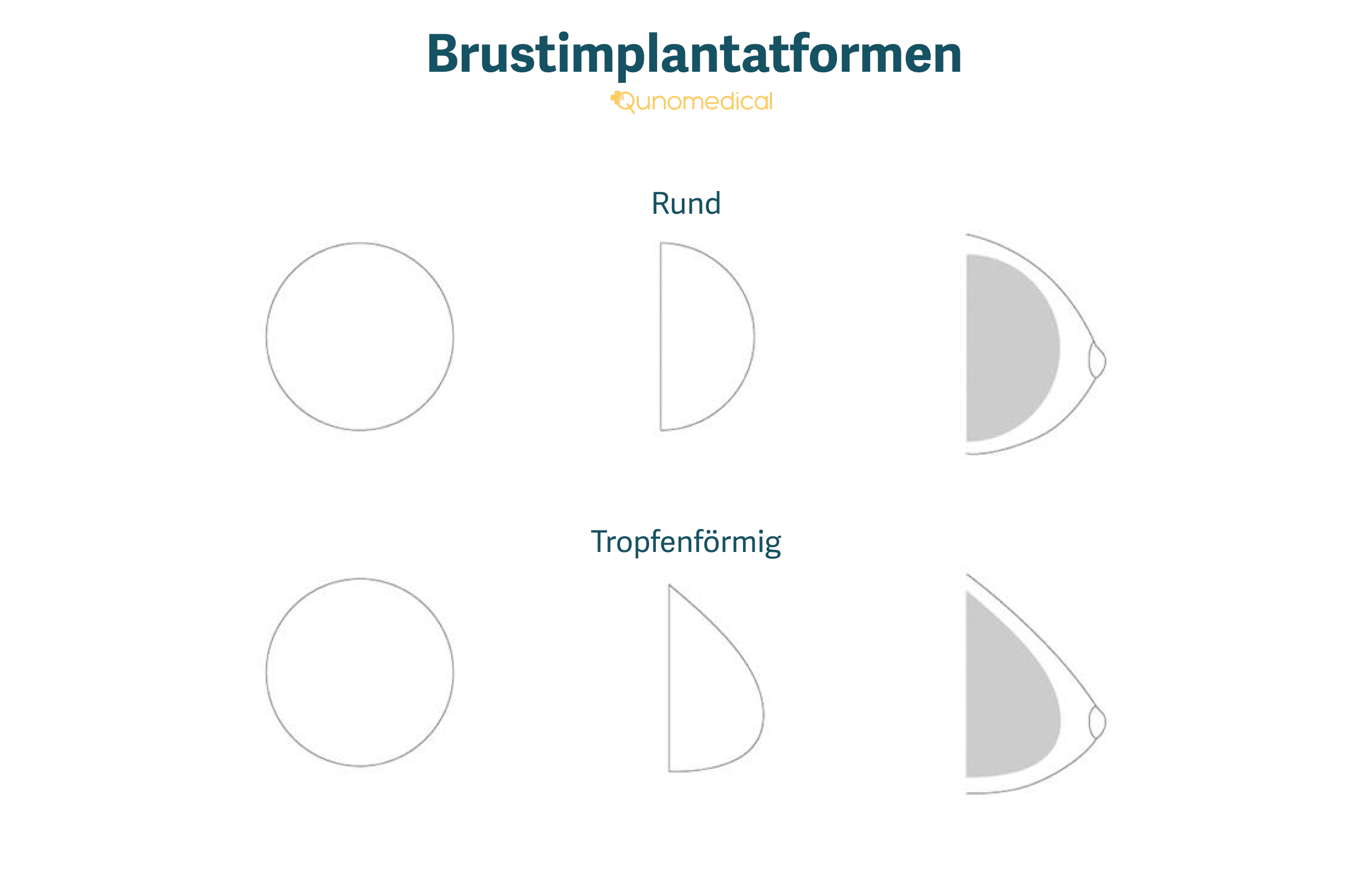Die verschiedenen Formen von Brustimplantaten.