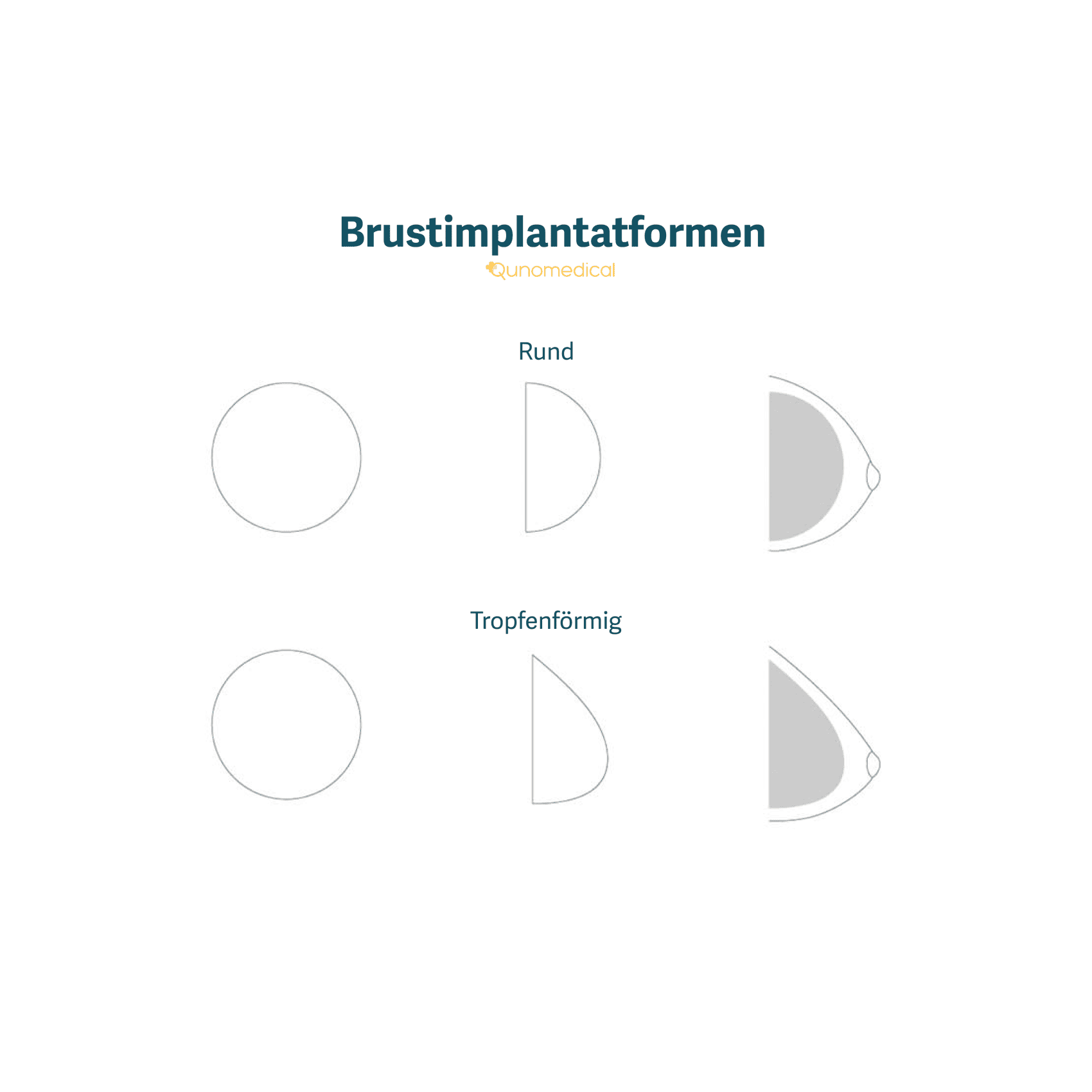 Die verschiedenen Formen von Brustimplantaten.