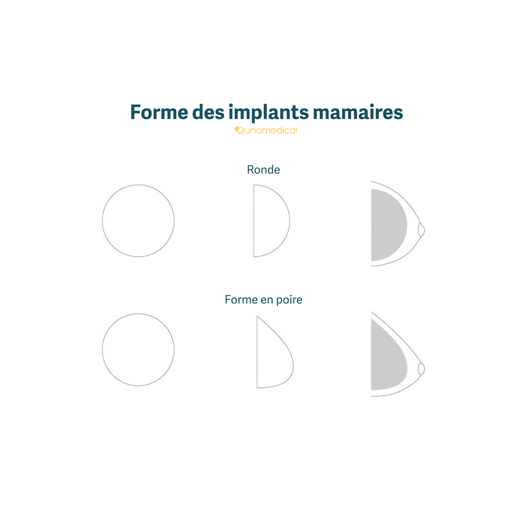 Les différentes formes d'implants mammaires.