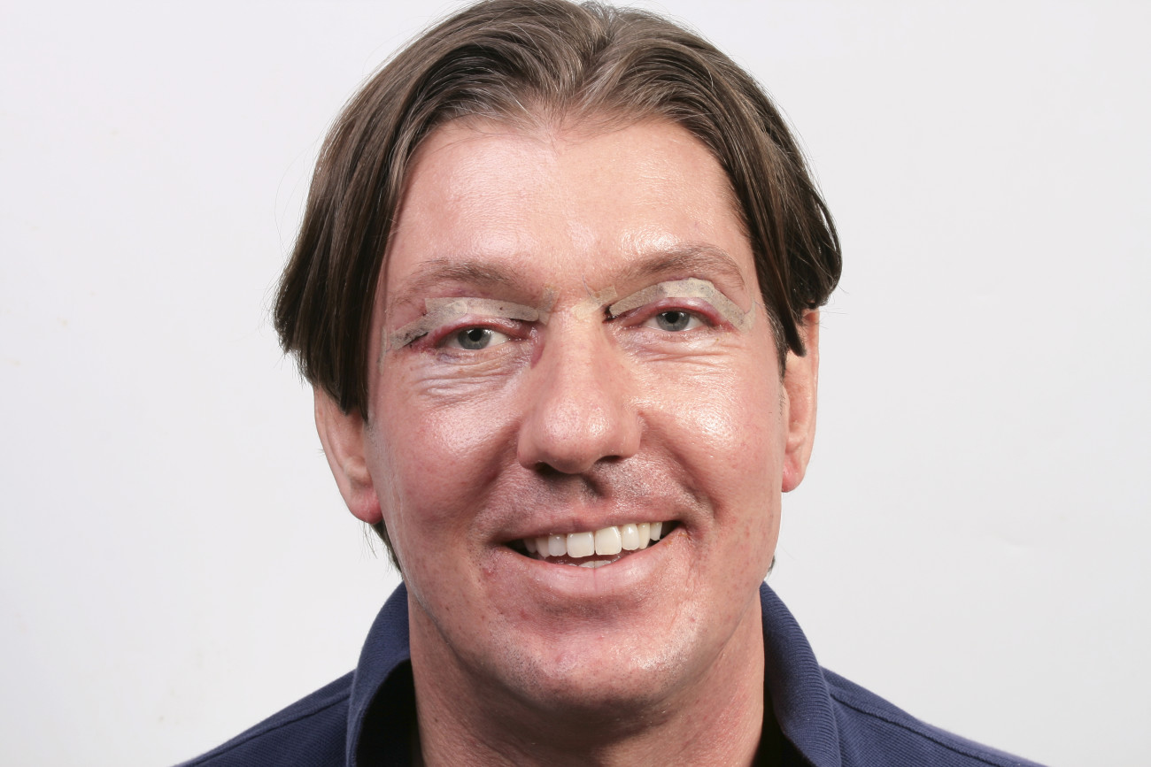 Image3_Plastic Surgery For Men: Trends And Procedures