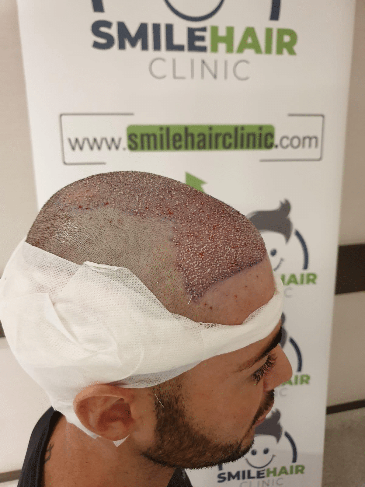 Qunomedical Interviews: Iwan's Hair Transplant in Turkey_Image2