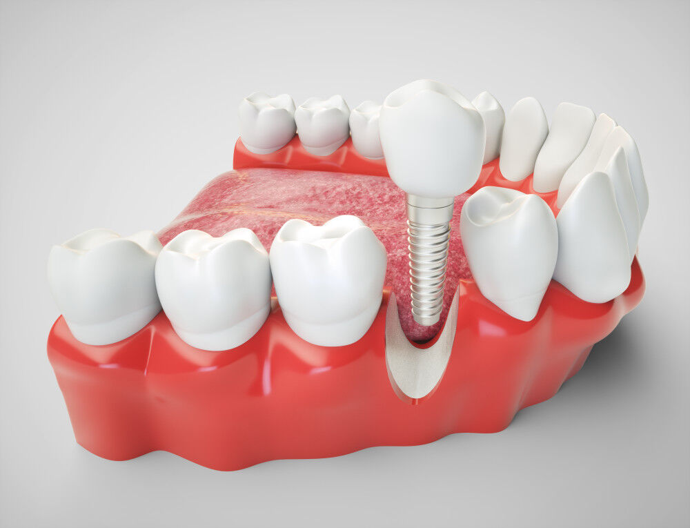 DE image 2 for Dental Implant Cost Guide