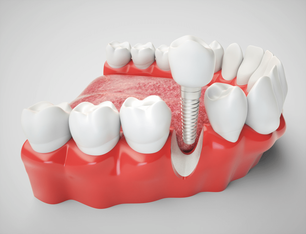 EN image 2 for Dental Implant Cost Guide