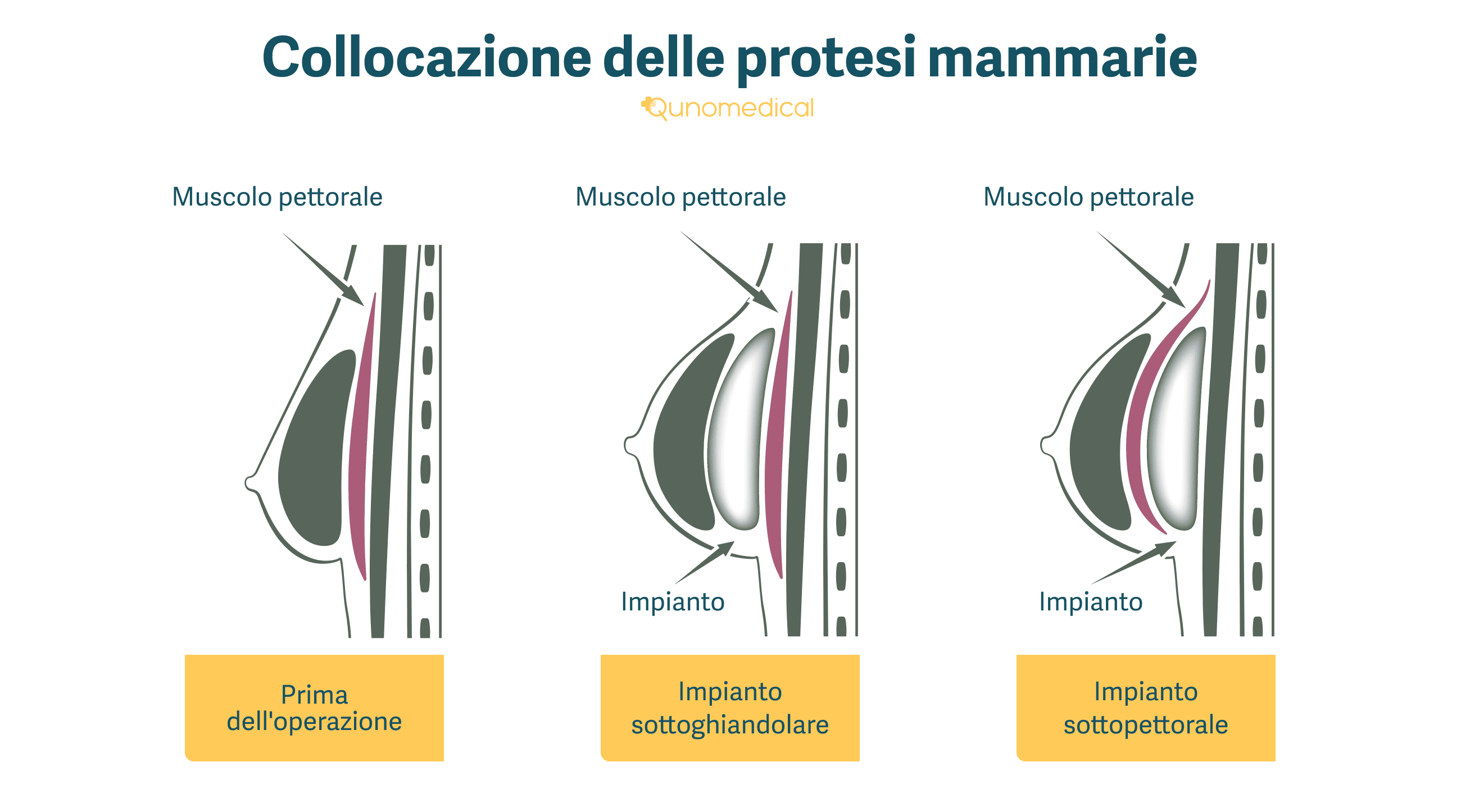 L’illustrazione mostra come vengono posizionate le protesi al seno.