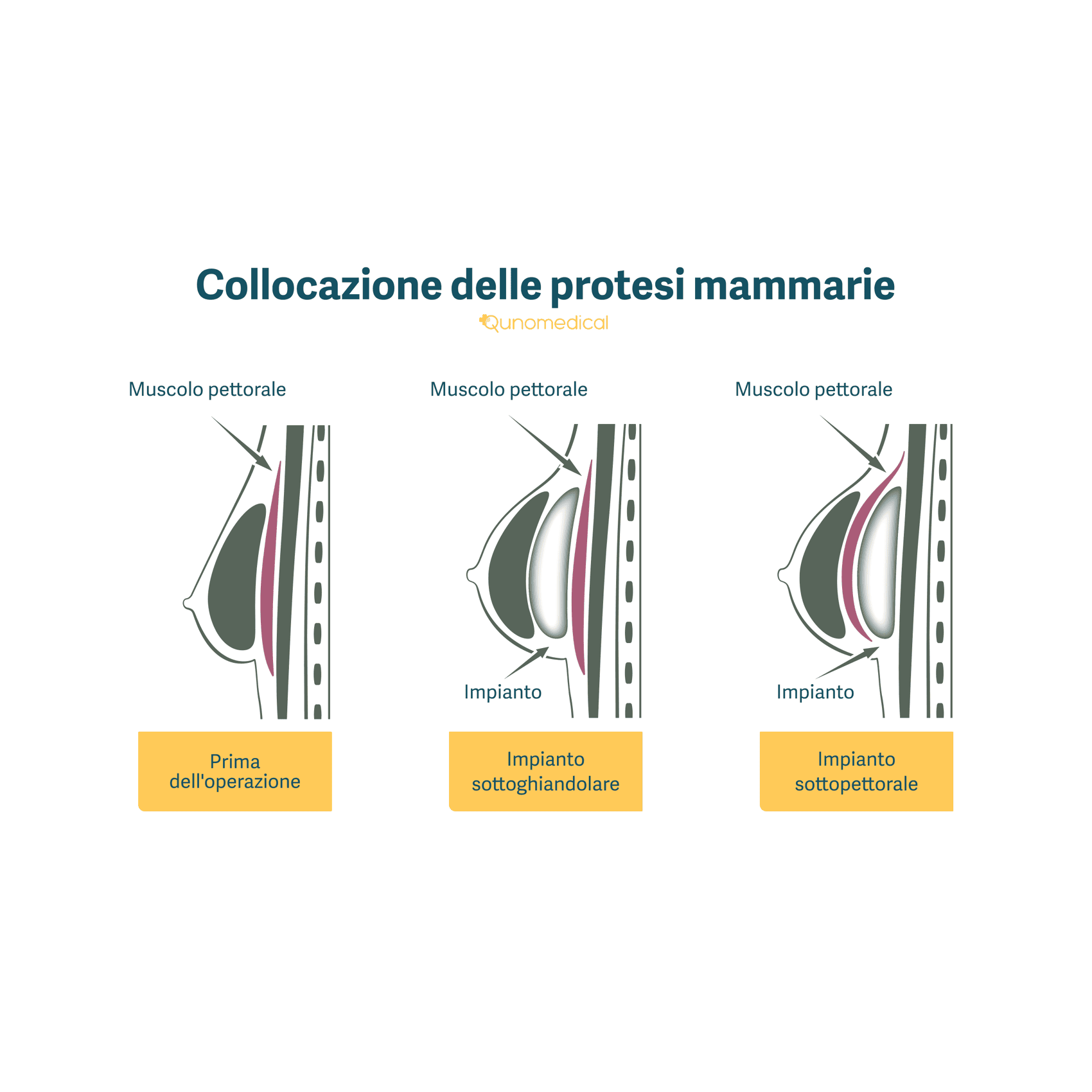 L’illustrazione mostra come vengono posizionate le protesi al seno.