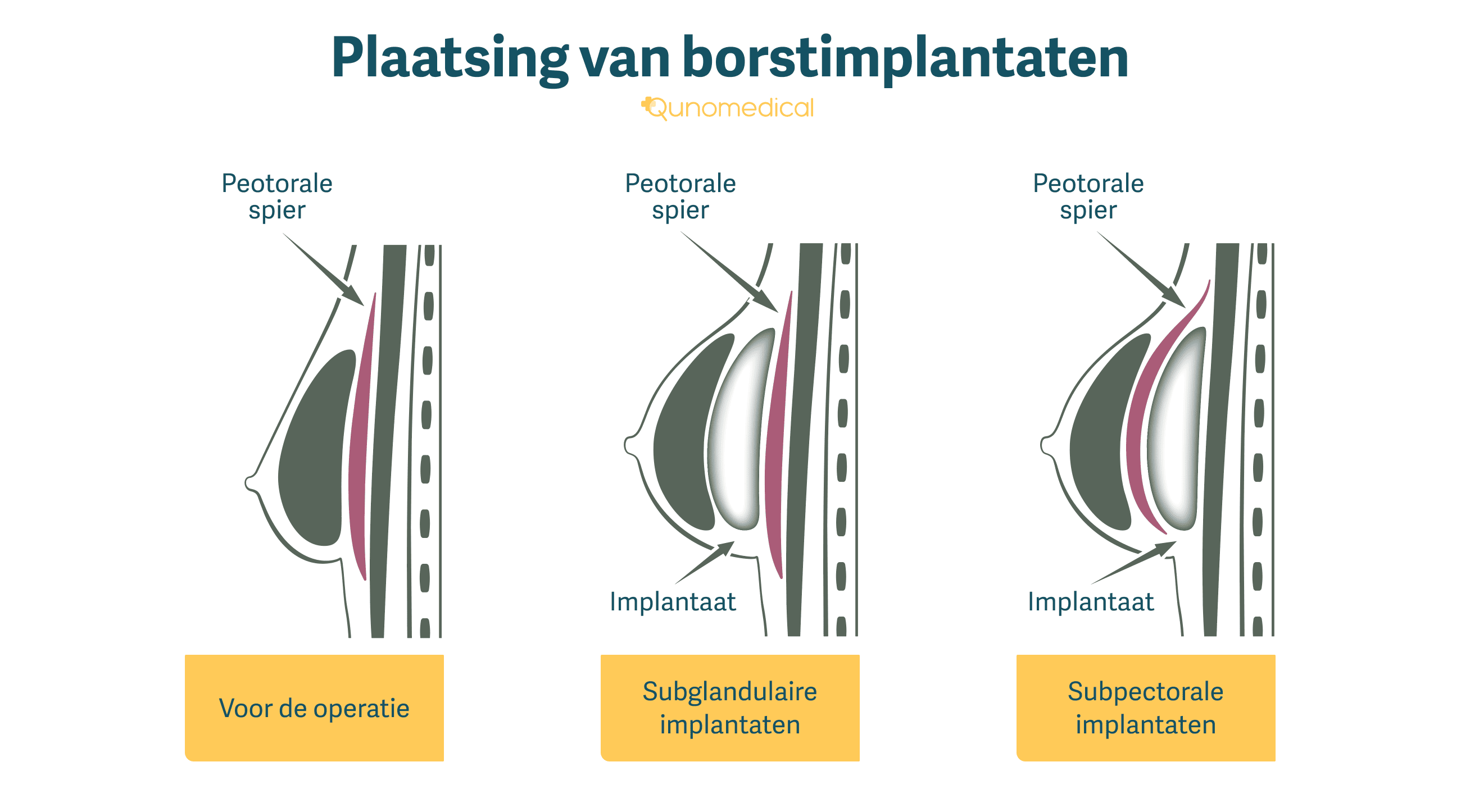 Illustratie die laat zien hoe borstimplantaten worden geplaatst.