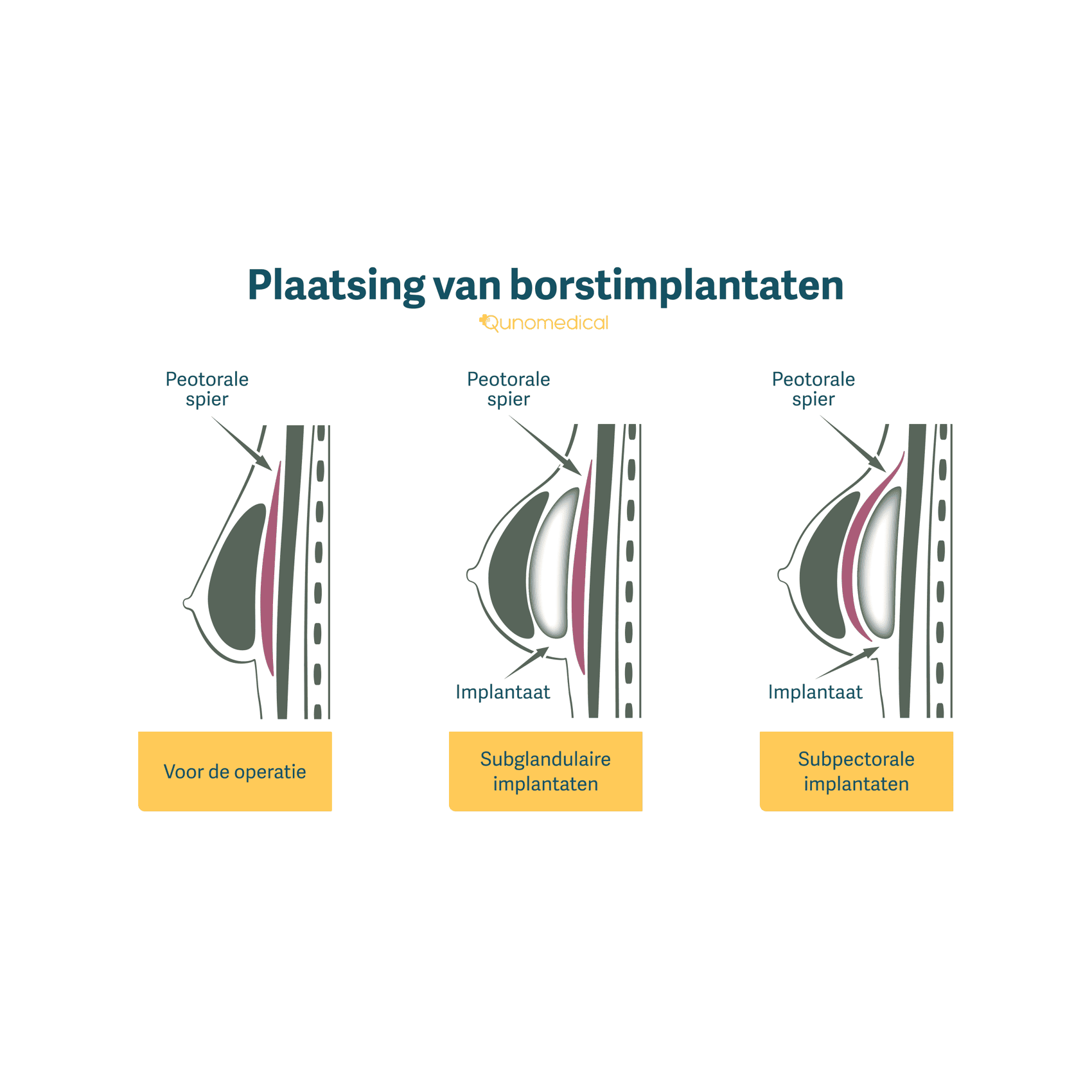Illustratie die laat zien hoe borstimplantaten worden geplaatst.