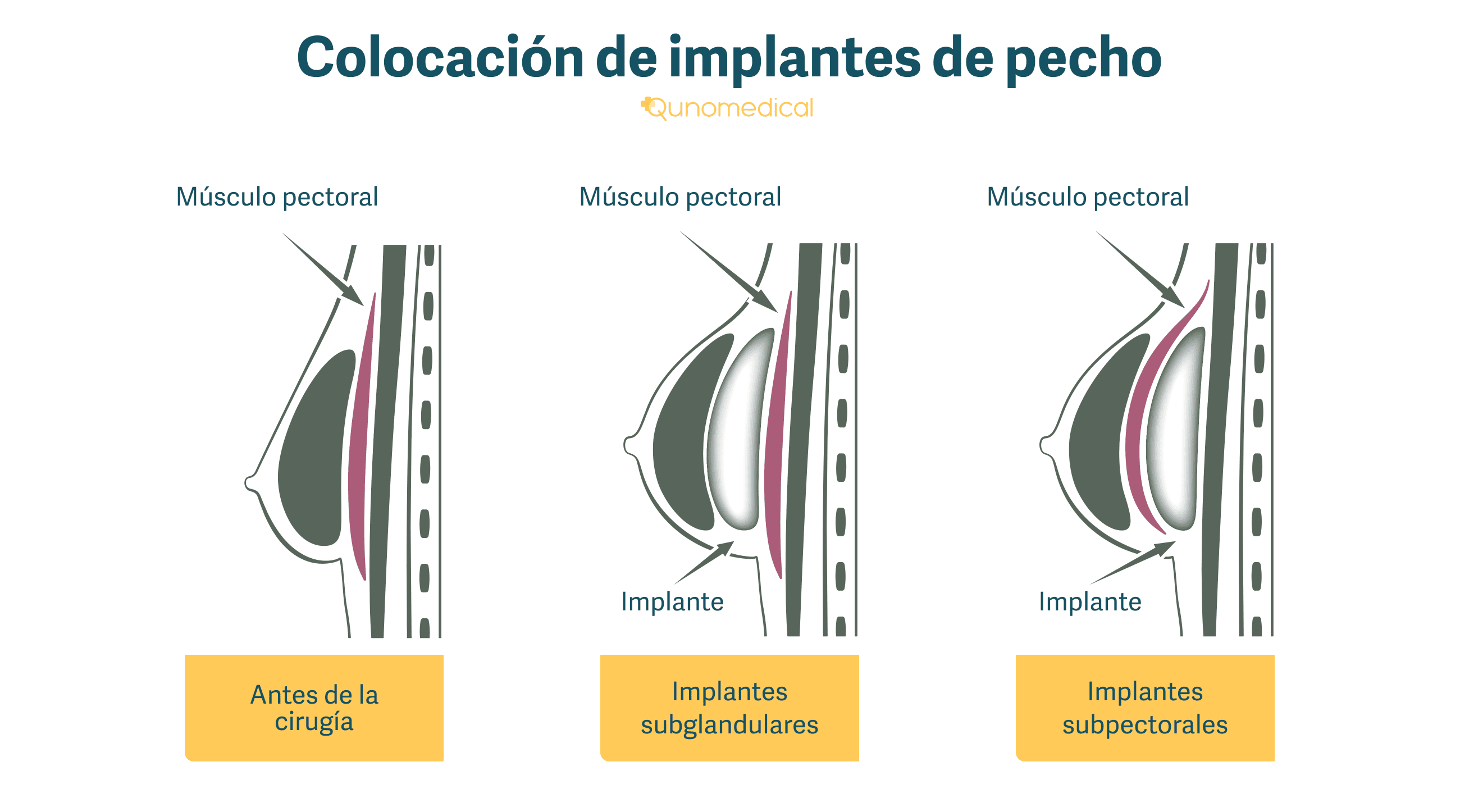 Ilustración que muestra dónde son colocados los implantes de pecho.