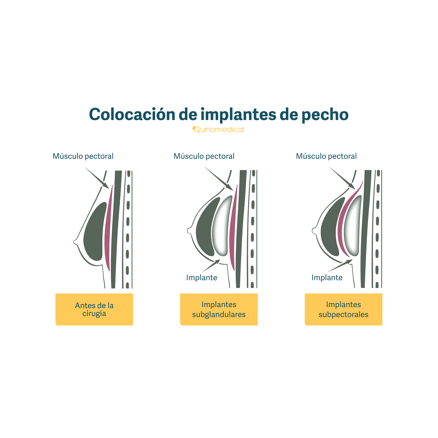 Ilustración que muestra dónde son colocados los implantes de pecho.