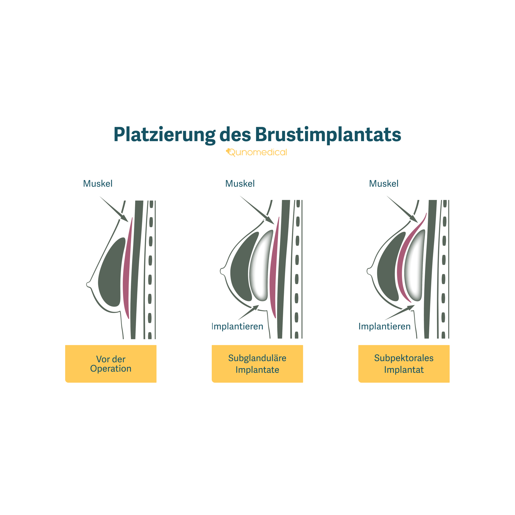 Diagramm, das zeigt, wie ein Brustimplantat-Insertionsverfahren funktioniert.