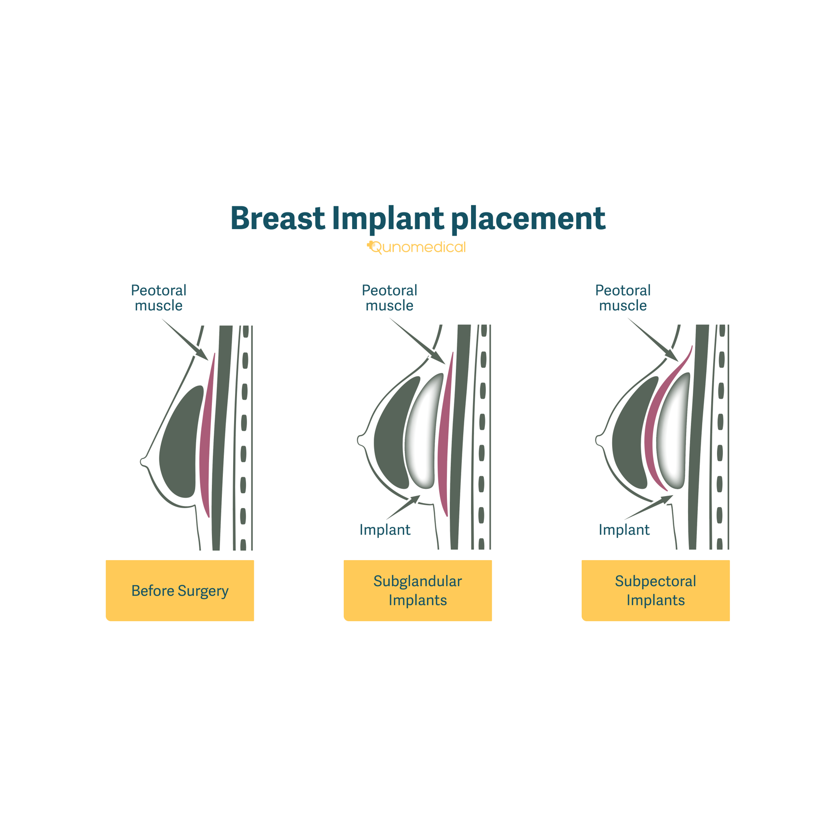 Illustration showing how breast implants are placed.