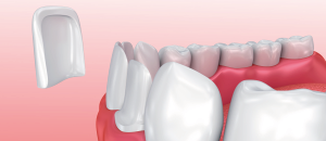 Diagram showing application of an aesthetic dentistry treatment.