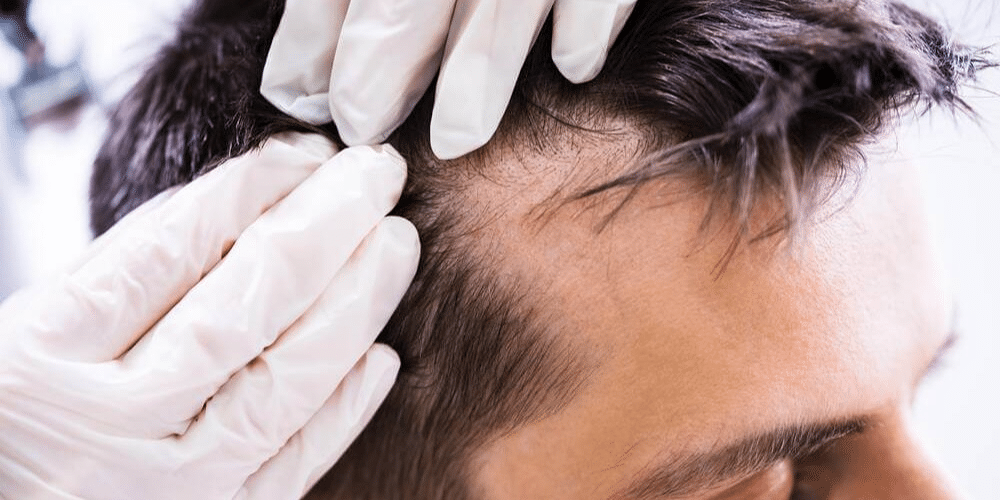 Dermatologist checking receeding hair