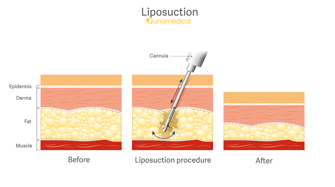 Diagram showing how liposuction surgery works.