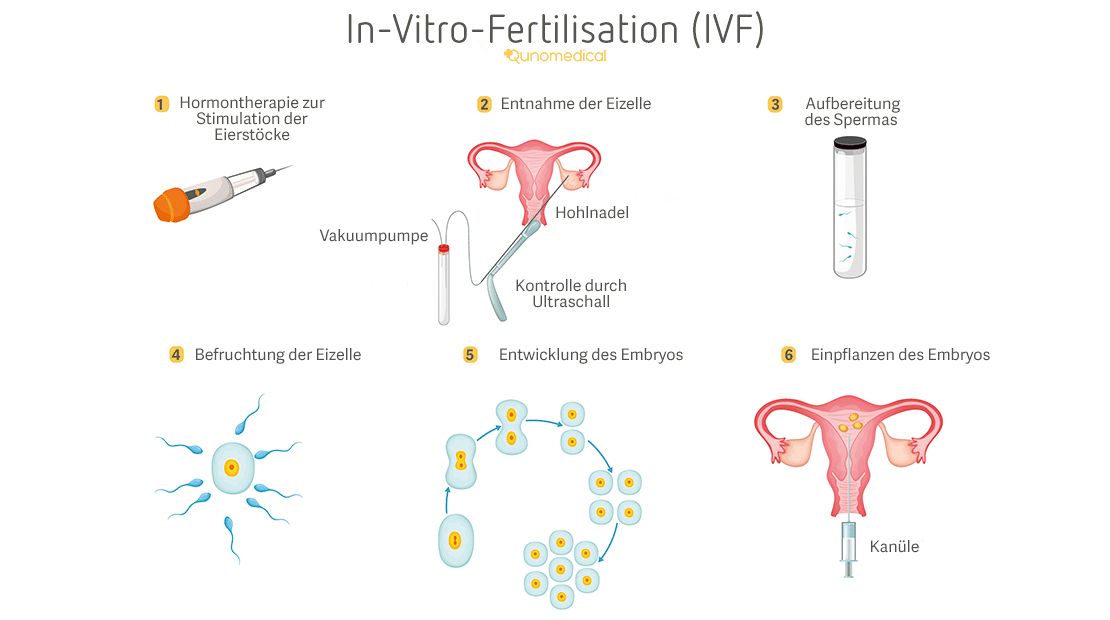 IVF-ablauf-zyklus jstz5i