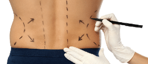 Patient planning a buttock and waist plastic surgery procedure.