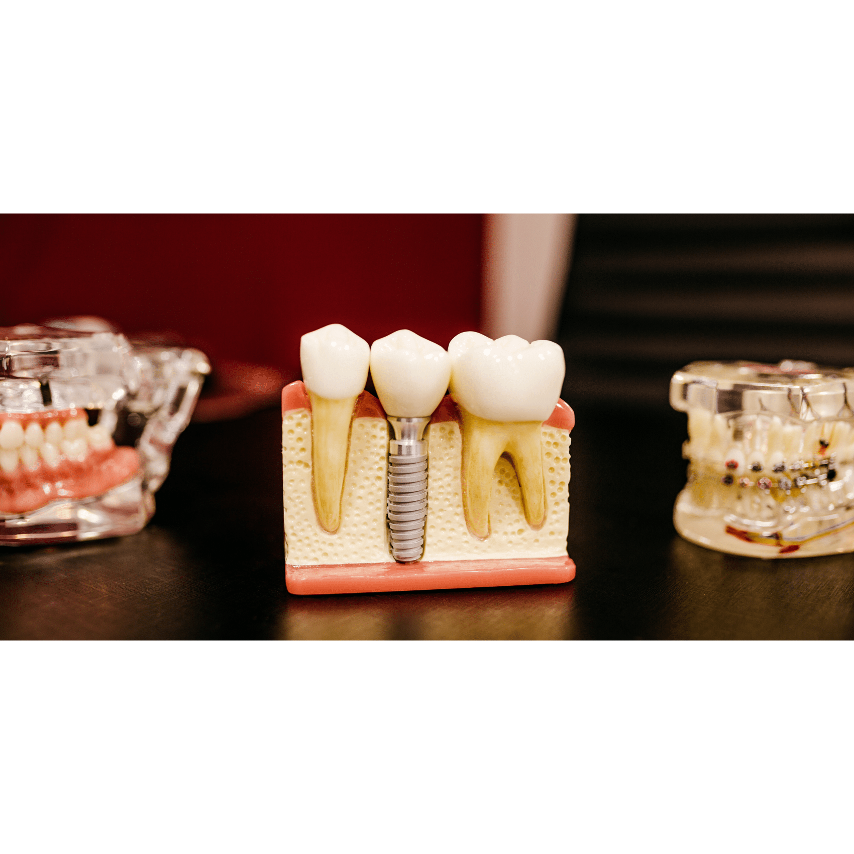 Blog_free-dental-implants-UK_image