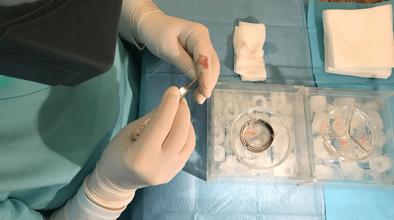 Doctor preparing hair grafts for implantation during a FUE hair transplant surgery.