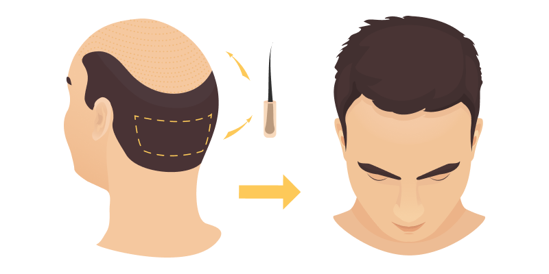Illustration showing the end result following a hair transplant procedure.