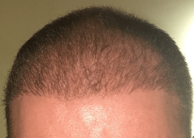 Image3_Patient Stories: Charles’s Hair Transplant - 5 Months Later