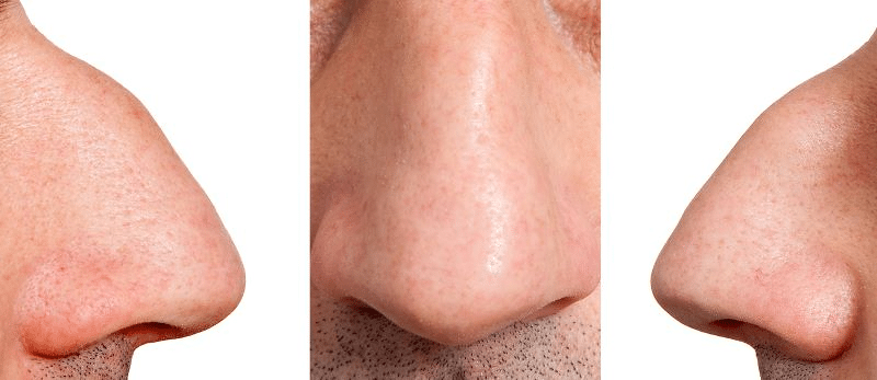 Man with Roman Nose
