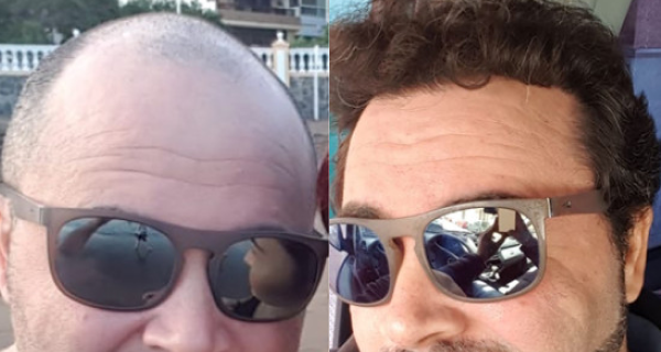 Uomo mostra i propri capelli prima e dopo il trapianto di capelli