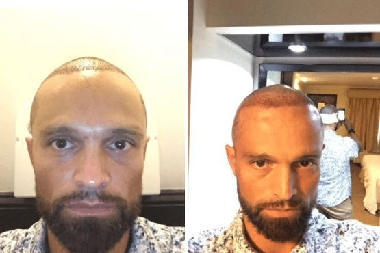 Image3_Freddy’s Hair Transplant Journey – Part 2: During Treatment