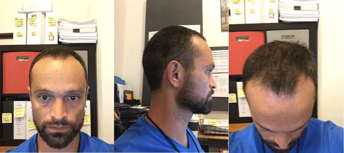 Freddy’s Hair Transplant Journey: 2 Months After Treatment